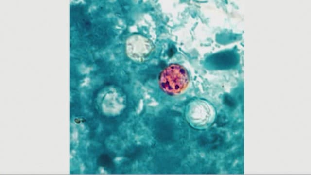 全米で6700人超に拡大の寄生虫感染症「サイクロスポラ症」　初の死者2人確認