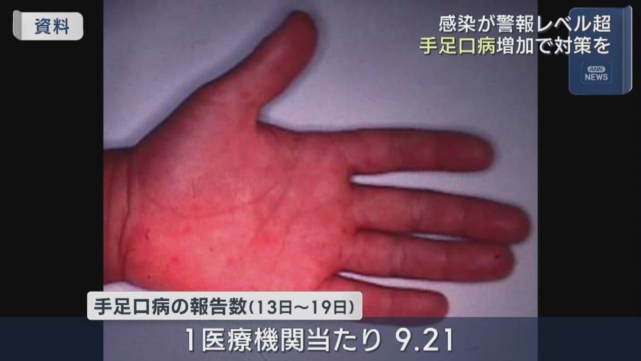 手足口病感染拡大　県内の感染状況が警報レベルを上回る