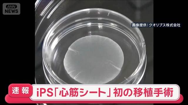【速報】iPS「心筋シート」初の移植手術 大阪市内の病院で 手術は滞りなく完了