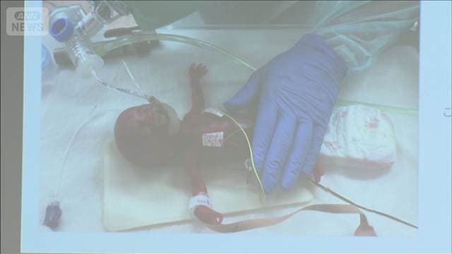赤ちゃんの心臓治療に成功 “世界最小”356gの時に