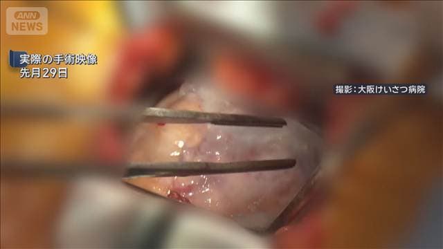 iPS細胞での移植手術成功 保険適用としては世界初
