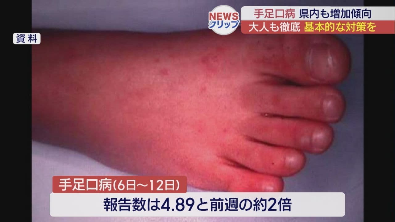 手足口病、福島県内で流行拡大 家庭内感染防止を徹底を