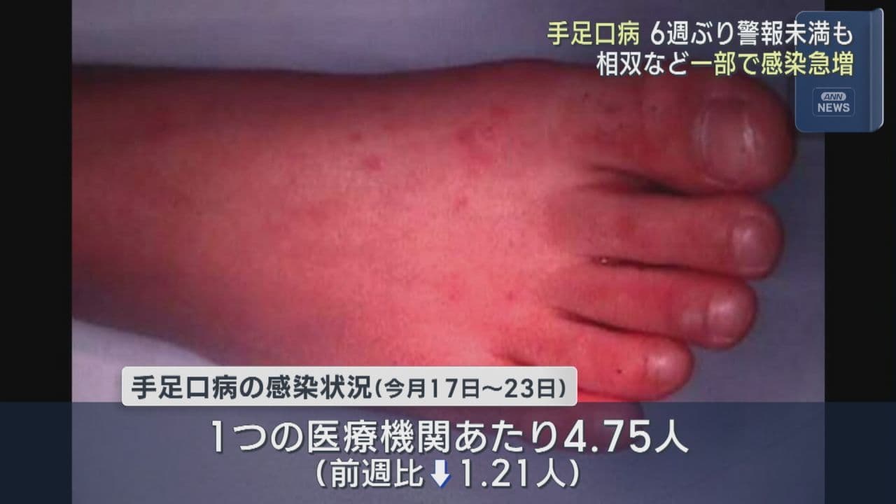 手足口病 警報レベル下回るも、相双で感染者急増